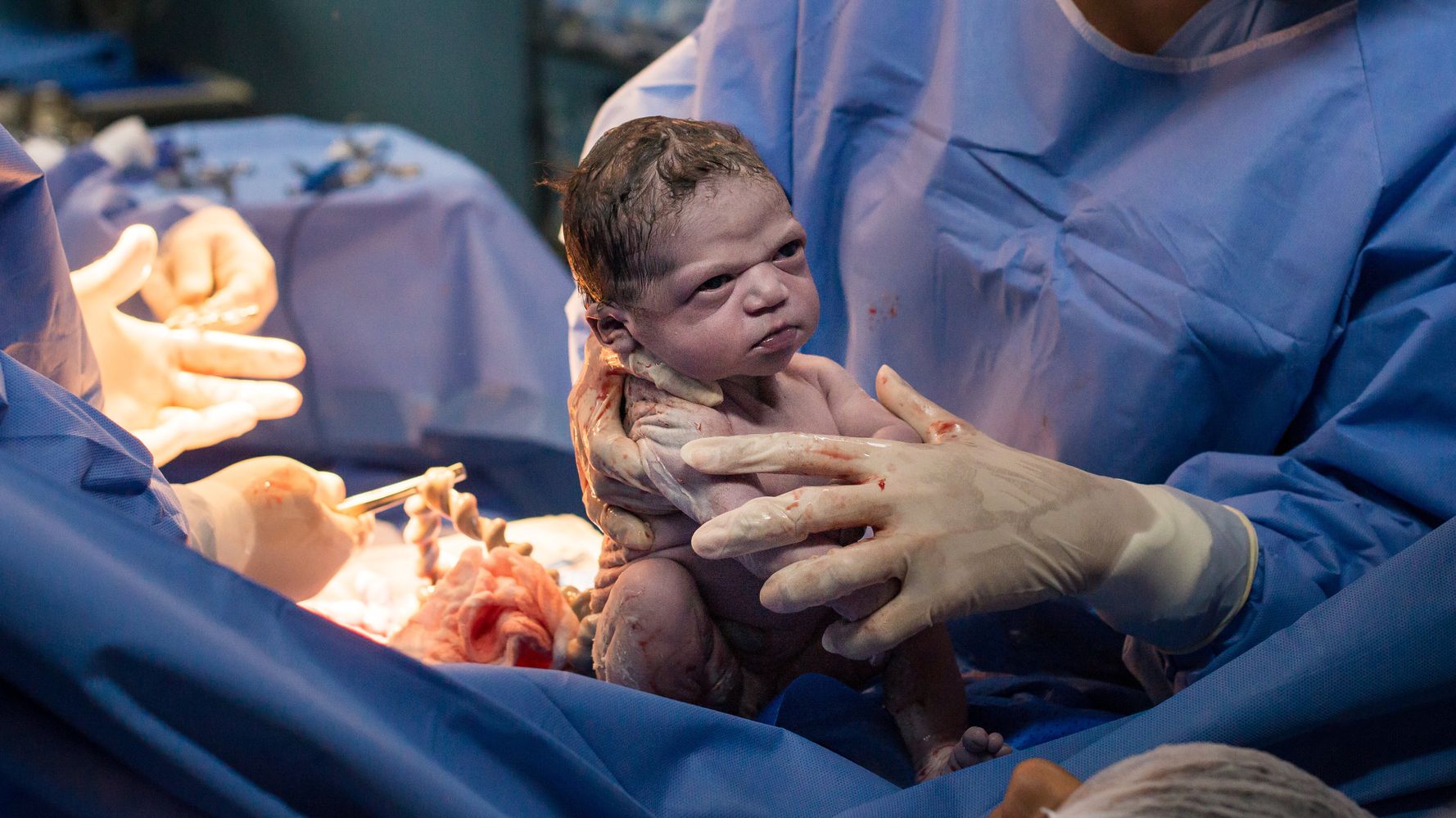 Newborn Baby Scowling At Doctors After Birth Goes Viral ...